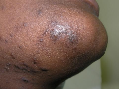 Laser Those Hair Bumps